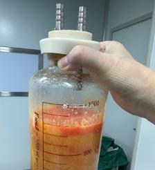 佛山水动力吸脂手术要做多久？